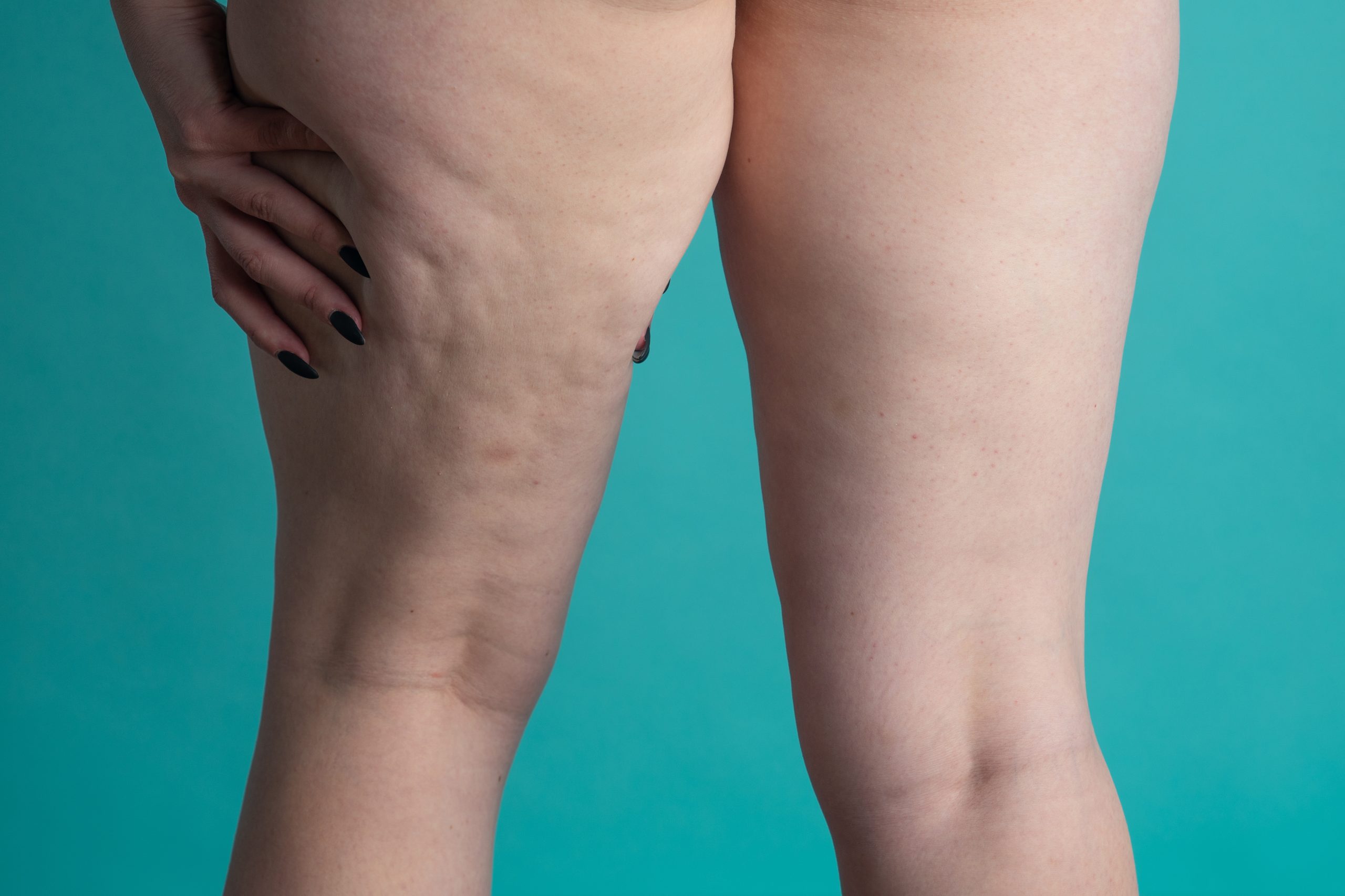Blog 2 lipedema scaled 1