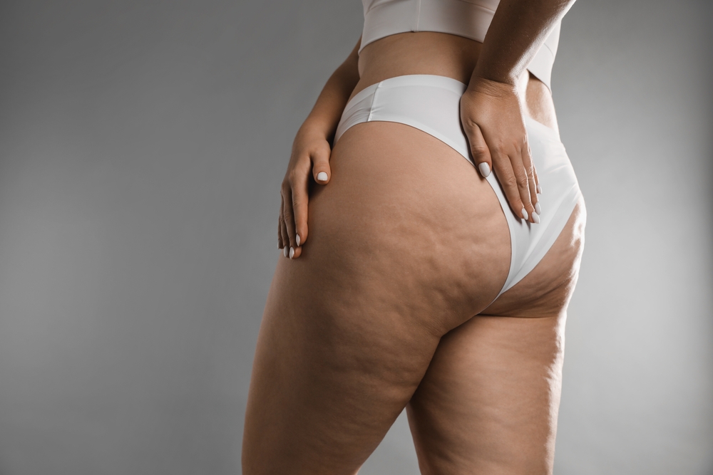 Blog 5 como saber se tenho lipedema