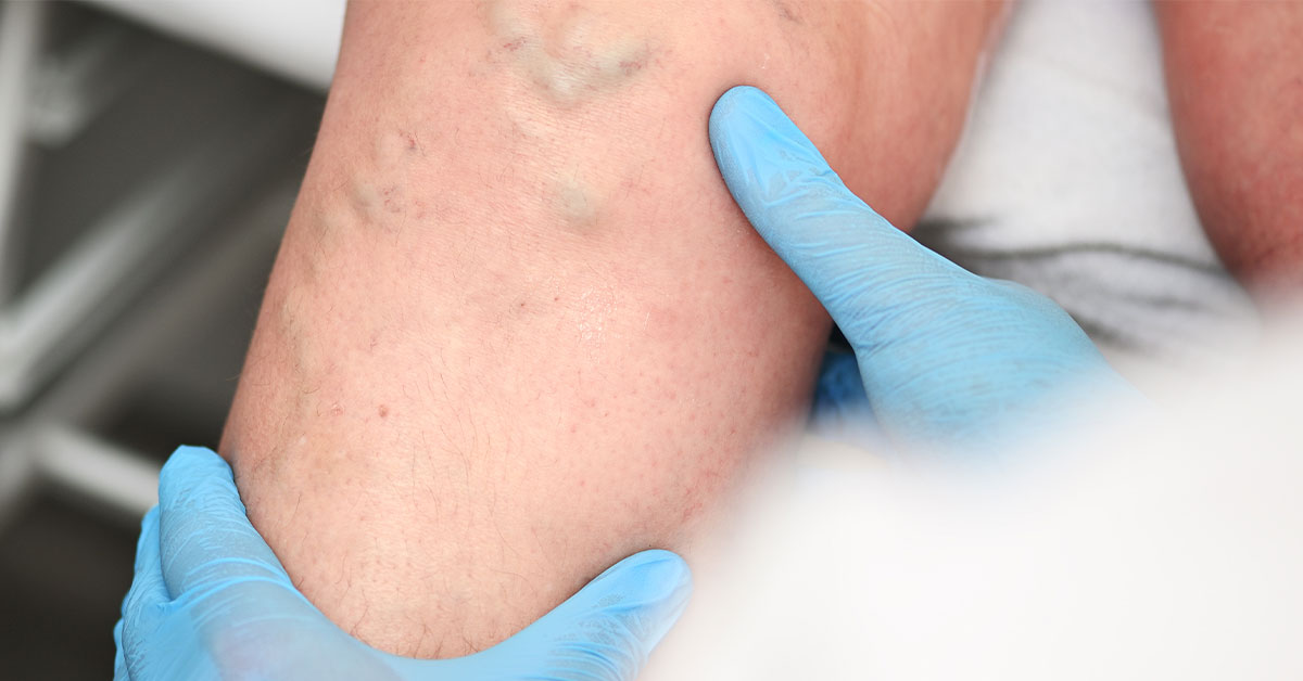 Blog 4 descubra os sintomas de linfedema
