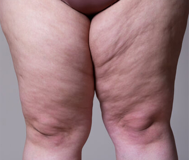 Vasinhos, lipedema e dor nas pernas 30 foto01