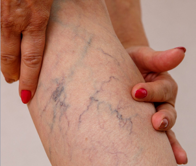 Vasinhos, lipedema e dor nas pernas 31 foto02