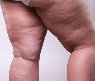 Vasinhos, lipedema e dor nas pernas 32 foto03