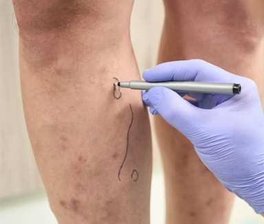 Vasinhos, lipedema e dor nas pernas 29 foto05