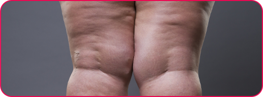 lipedema